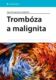 Trombóza a malignita (e-kniha)